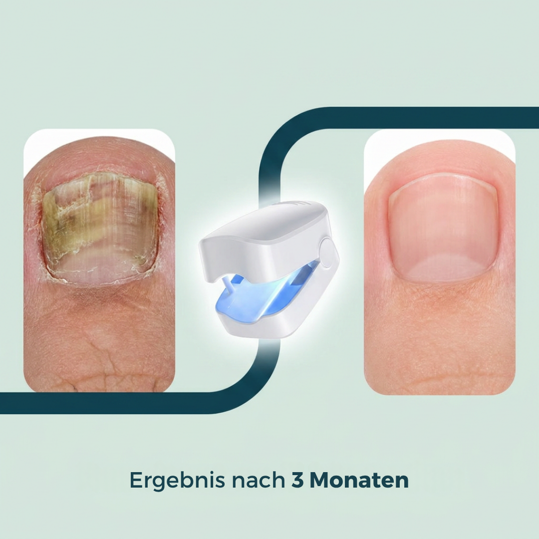 ClearNegl™ - Verabschiede dich für immer von verfärbten und ungesunden Nägeln!