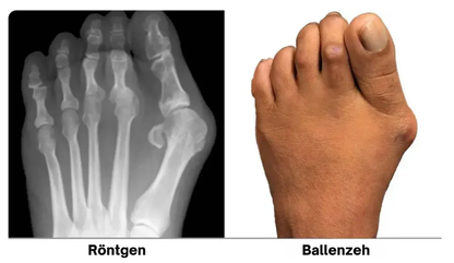 ZehFix™ - Korrigiere deine Zehen sanft und bequem!